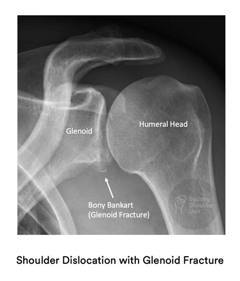 best test for labral tear|shoulder labrum tear x ray.